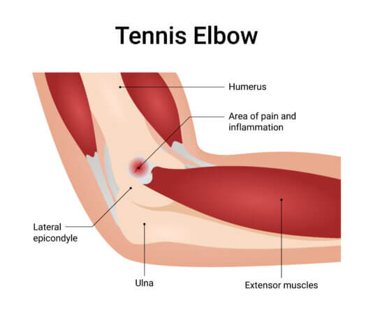 Łokieć tenisisty - czym jest, przyczyny, objawy i skuteczne leczenie